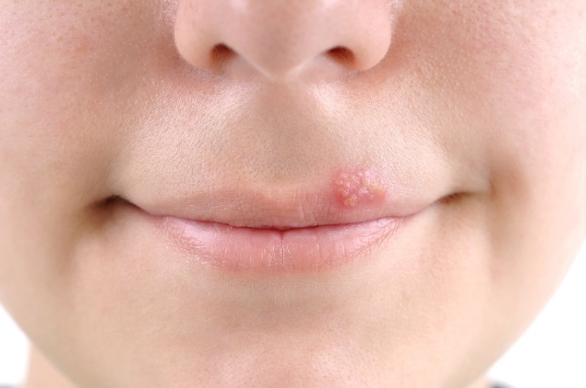 Blisters - cold sores (herpes) around the lining of the mouth.