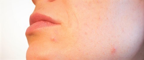 Woman's face, cutout, detail on the skin of the chin, rash, acne as a result of oily skin