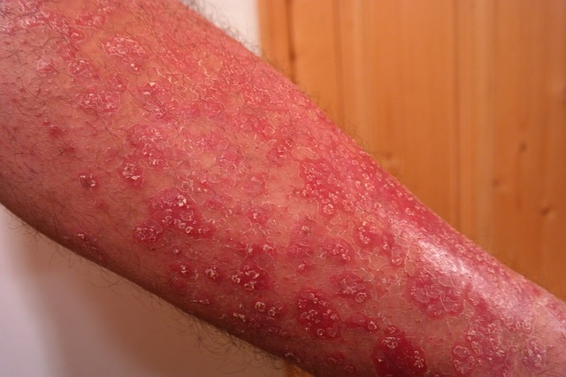 Psoriasis on the forearms, scaly, reddened skin, with loss of hair