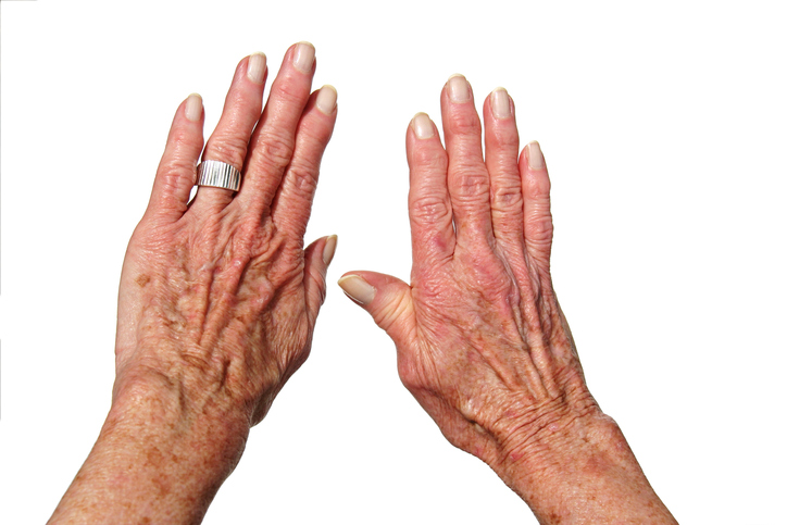 two hands, arthritis, rheumatism, painful and swollen joints of the fingers