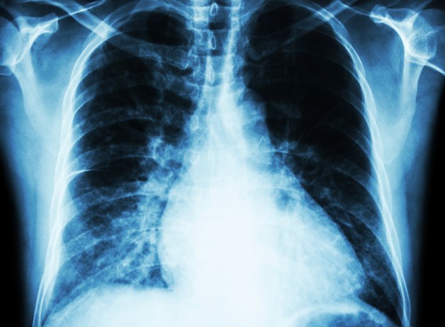 Chest X-ray, heart - magnification