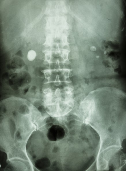 X-ray of the abdomen, kidney stones on both sides, in both kidneys