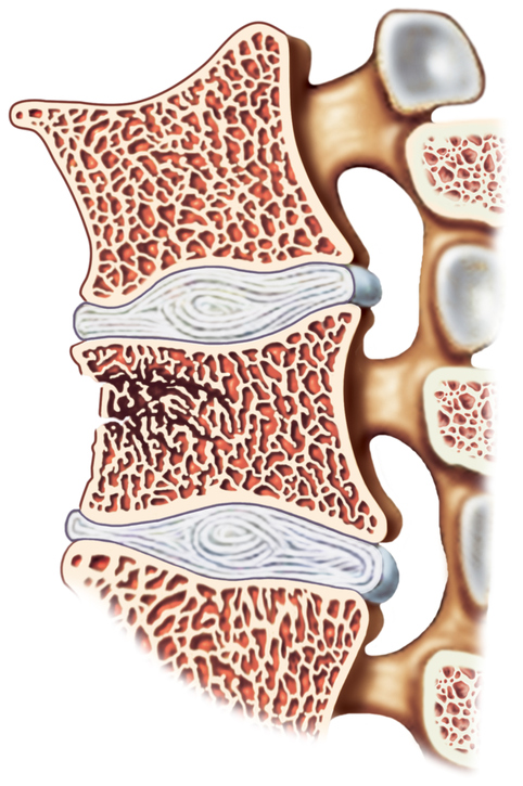 spine, representation of vertebrae and intervertebral discs, vertebral fracture