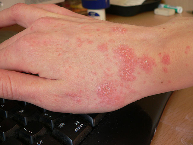 scabies on hands, redness, infectious skin diseases