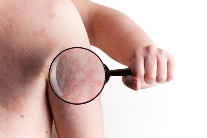 Psoriasis on the shoulder - under a magnifying glass