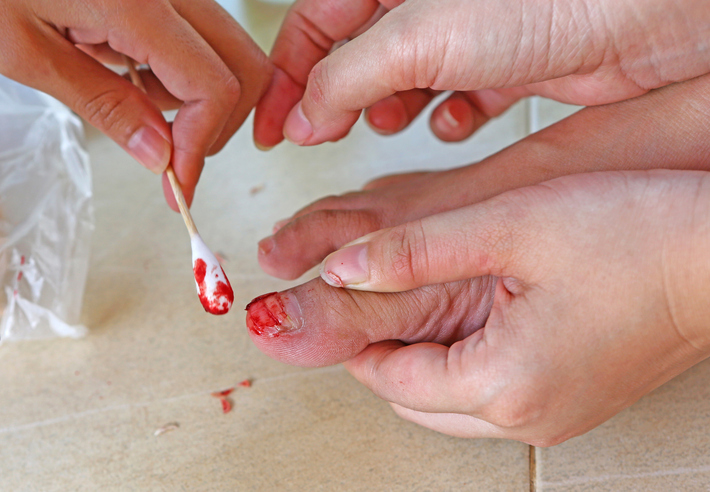 Damage to the nail by injury, bleeding, treatment with a cotton swab