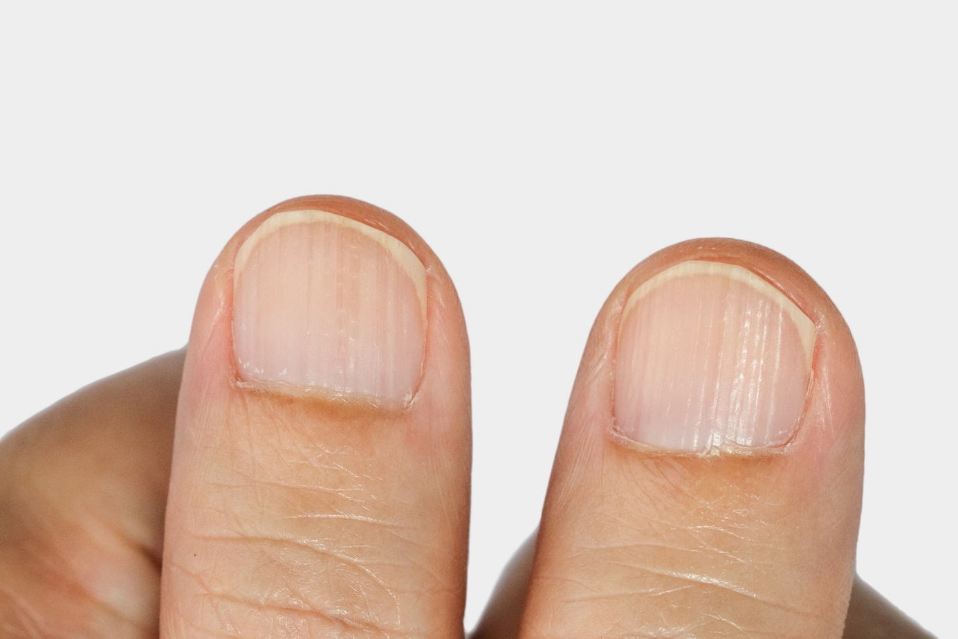 Vertical grooves on nails - finger, nail and grooves