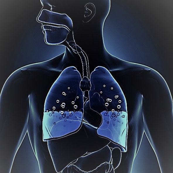 Schematic representation of lungs with swelling, water in the middle of the lungs, airways