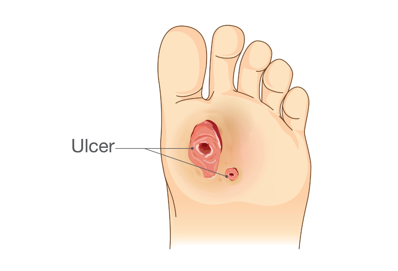 Ulcer on the foot