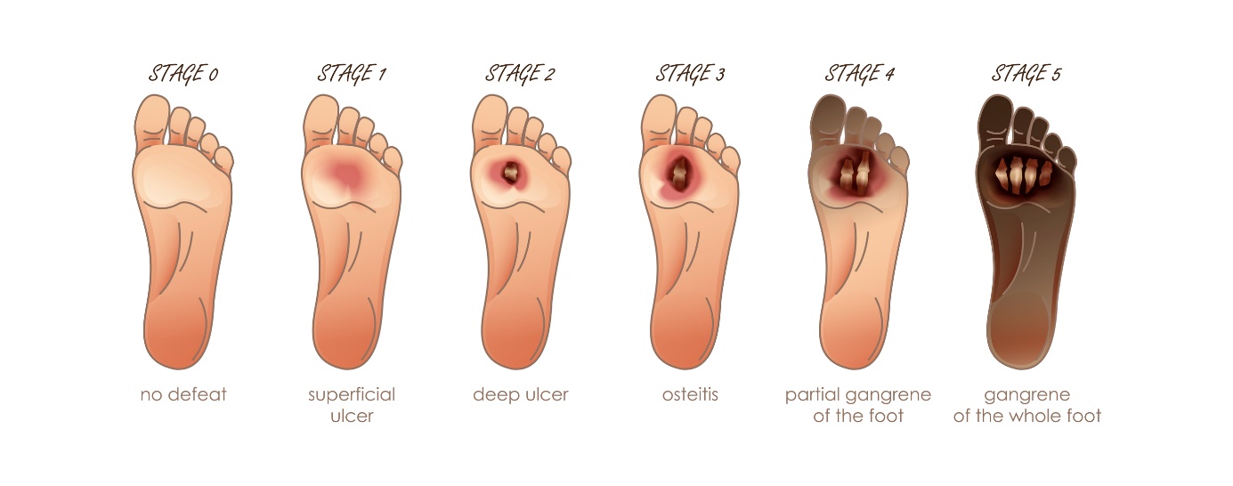 Foot ulcer disease and its stages