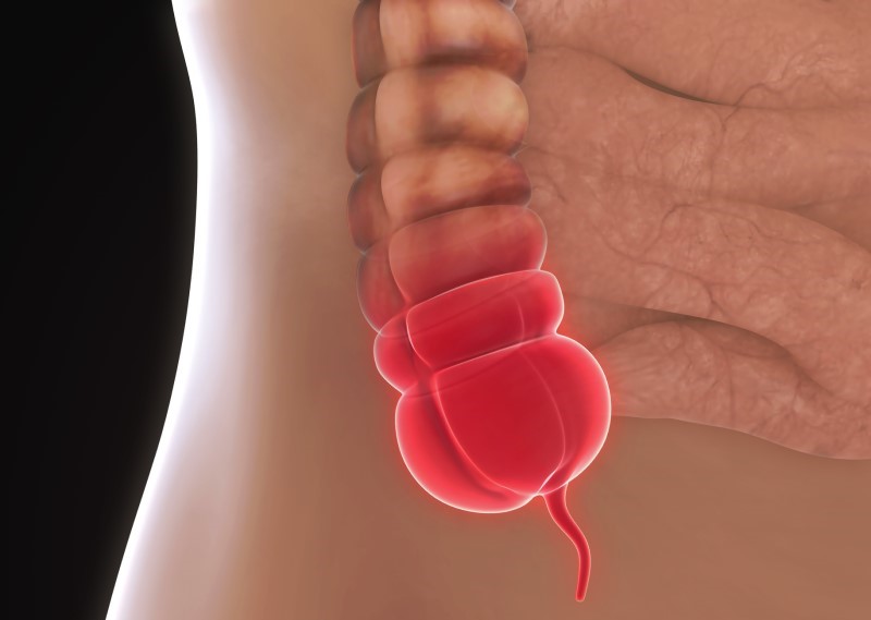 Model of inflamed appendix - anatomical view.
