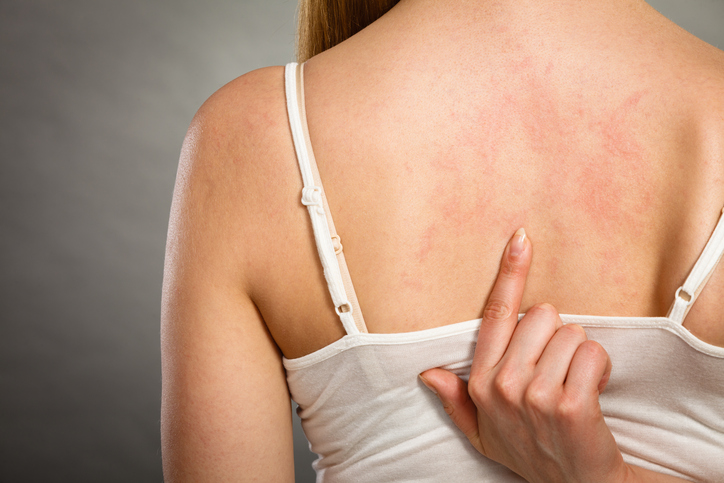 The woman has hives on her back, so she's pointing her finger at it.