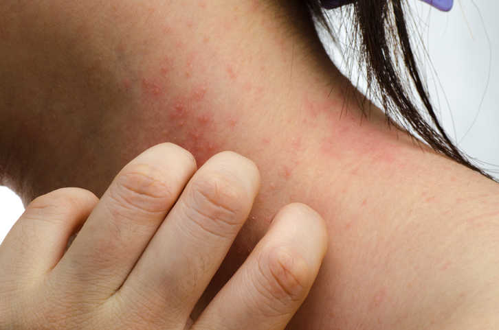 A woman scratches her neck, itching skin inflammation, redness and rashes on her neck