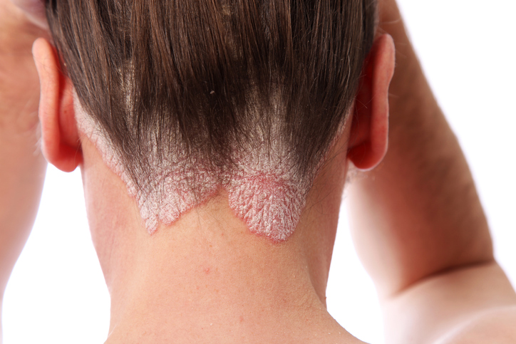 a woman has psoriasis in the hairy part of her head, part of the head of her head