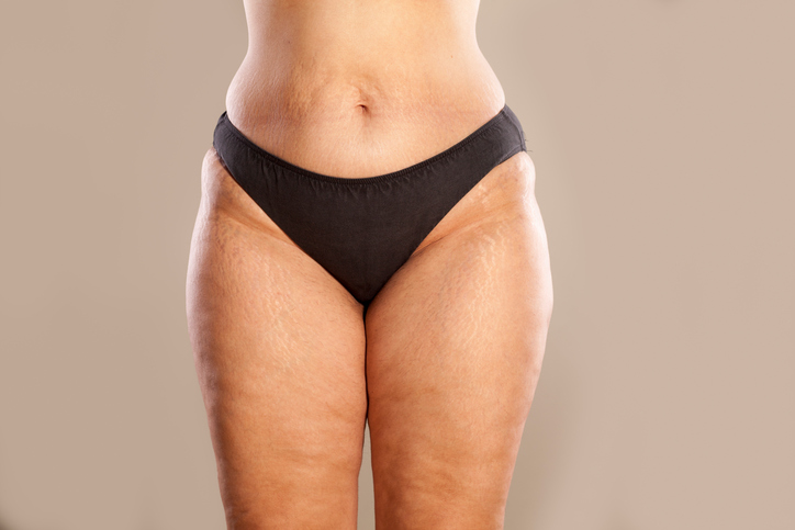 Cellulite, thighs, woman