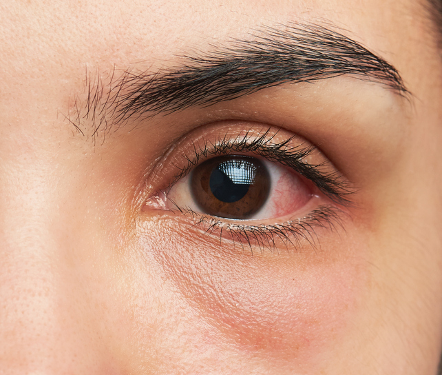 Woman, eye, close-up, inflammation