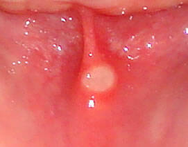malá afta na sliznici ústnej dutiny
