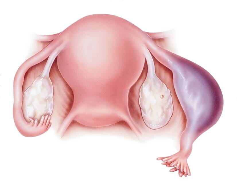 The development and growth of the fertilized egg in the fallopian tube, threatening its rupture and subsequent bleeding. Source: Getty Images
