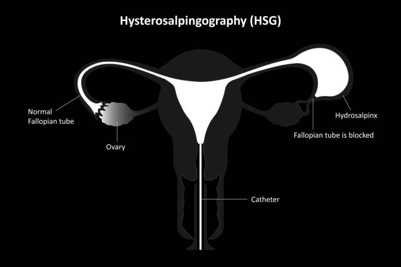 Hysterosalpingography. Photo source: Getty Images.