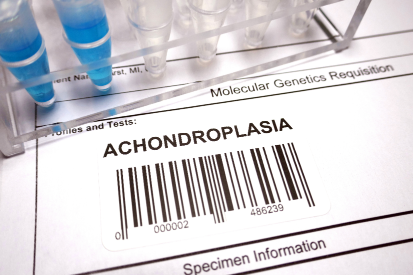 Achondroplasia: What are the causes, symptoms of congenital bone disorder?