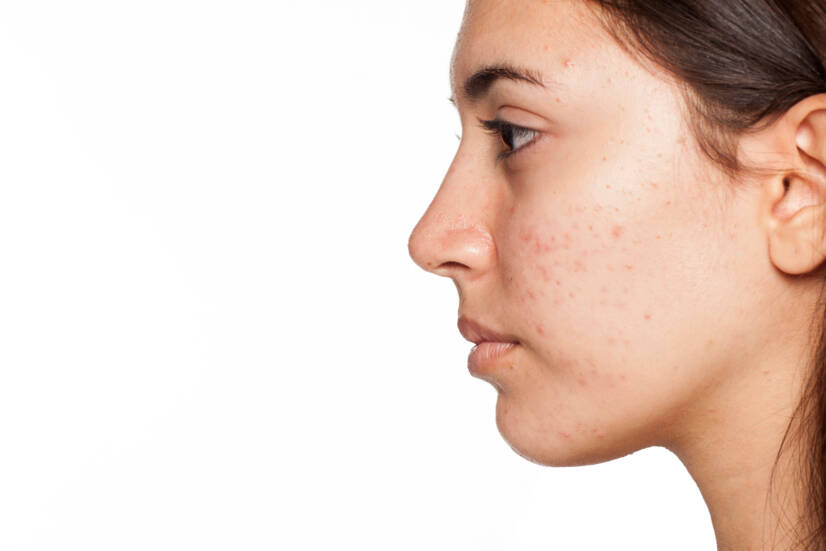 Acne: Types and Treatment