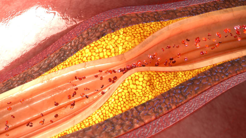 Atherosclerosis: Do you know the symptoms or causes, risks, prevention?