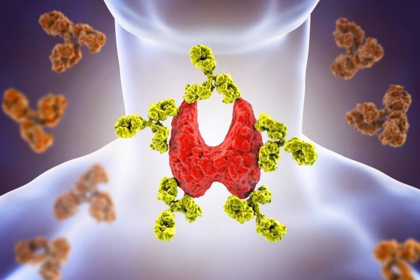 Autoimmune thyroiditis: Hashimoto's disease. Causes, symptoms