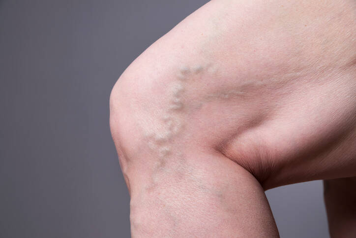 What are varicoses, varicose veins? Why they appear, how they manifest and cure 