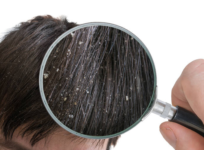 Dandruff: Why does it appear, how to get rid of it? (will granny's advice and home treatment help?)