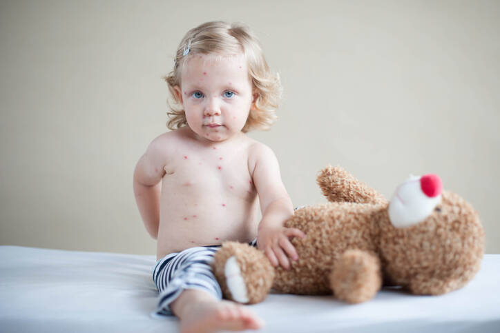 Chickenpox: How does it manifest, what does it look like? Adults with complications