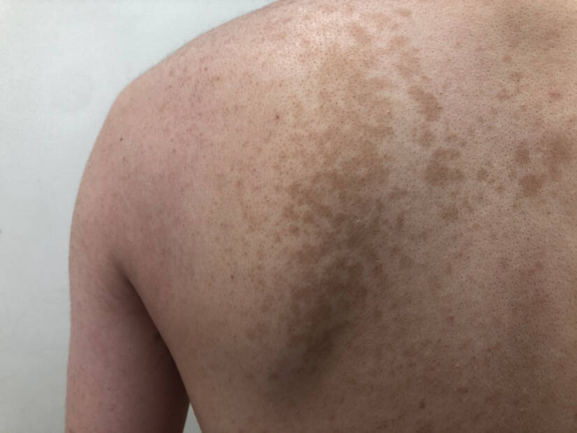 Pityriasis versicolor: What is it and what symptoms does it have? Causes and transmission