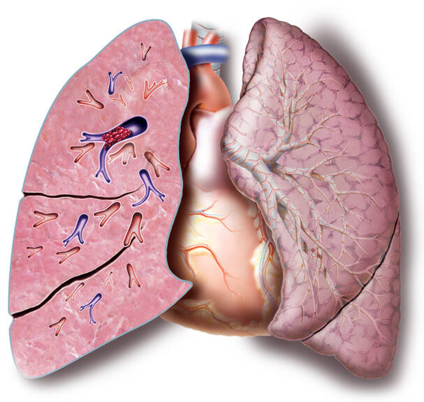 Pulmonary embolism: causes, symptoms, probability testing, and treatment