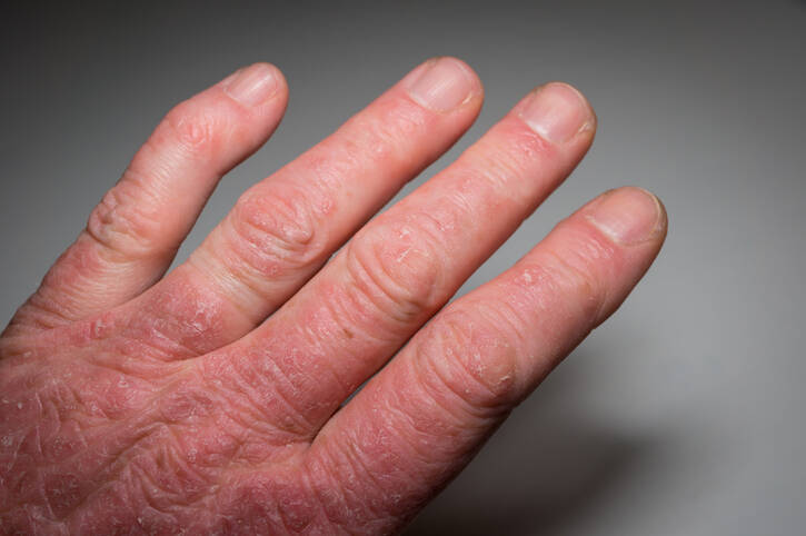 Psoriatic Arthritis: Causes and Manifestations of Psoriasis with Joint Infection