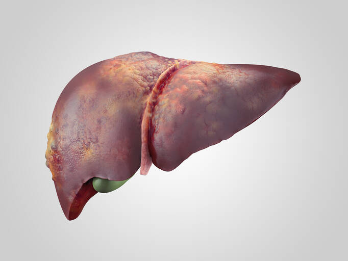 Liver Cancer: Causes, Manifestations, Treatment