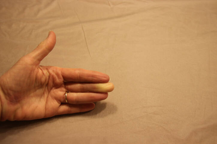 Raynaud Syndrome: Causes of Reduced Blood Flow to the Fingers