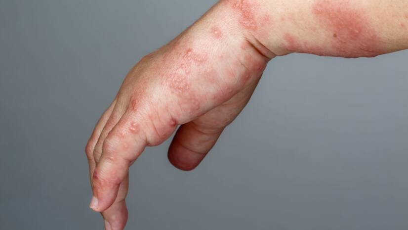 Scabies: What it is, How to Recognise its Symptoms and How to Get Rid of it