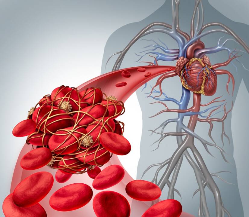 Thromboembolic disease: origin and how it relates to pulmonary embolism