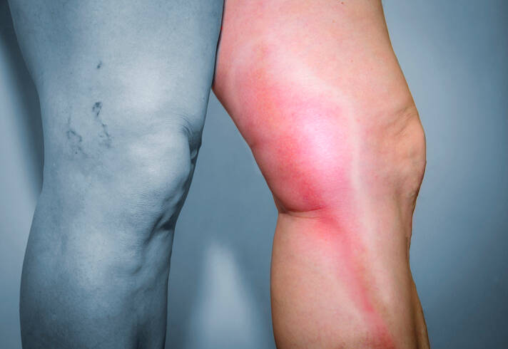 Thrombophlebitis of superficial veins: What is phlebitis and why does it occur?