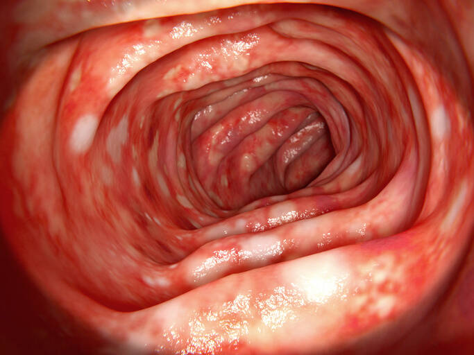 Ulcerative Colitis: Causes, Symptoms, Diagnostics