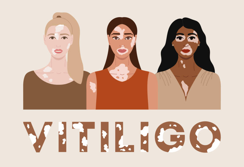 Vitiligo: What is vitiligo and what are its causes and symptoms? When does it start?