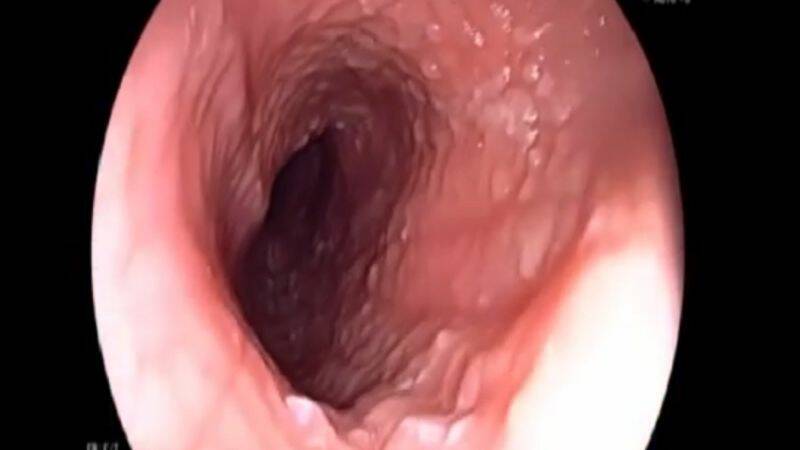 Esophagitis - Inflammation of the Oesophagus