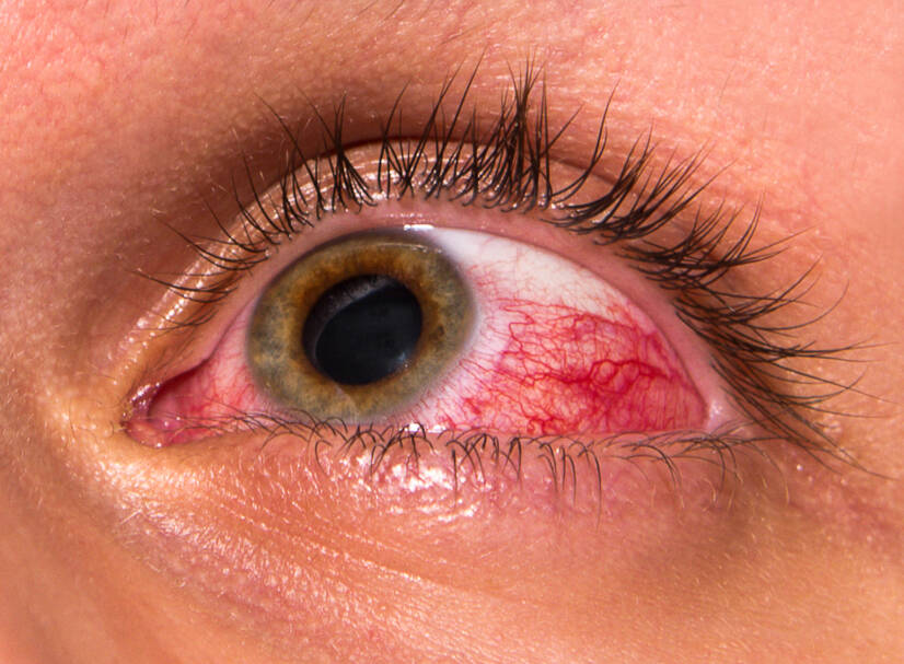 Conjunctivitis: Causes and Symptoms
