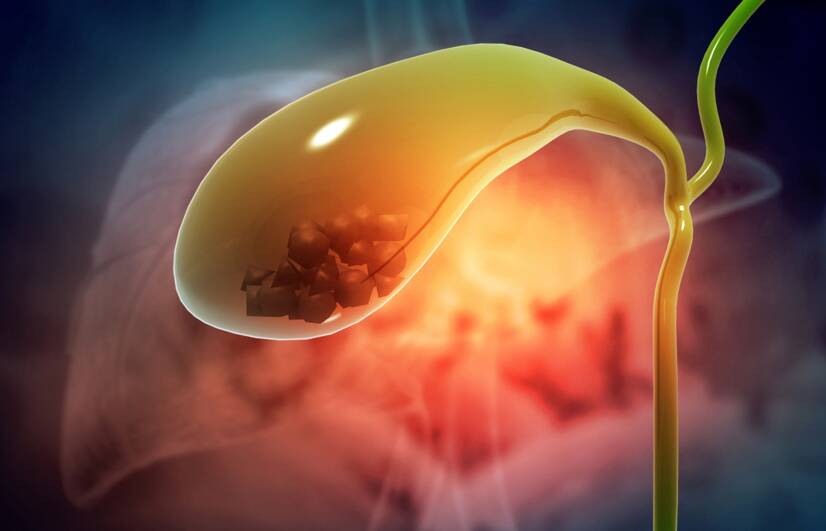 Gallbladder stones: what is it, what are their causes and symptoms?