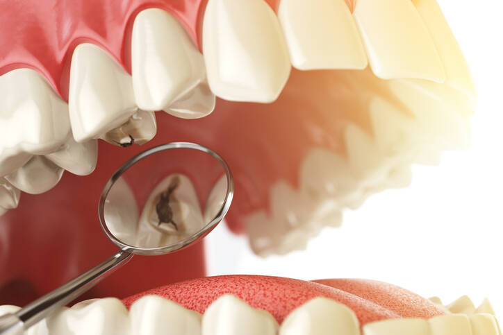 Tooth Decay: Causes and Manifestations 
