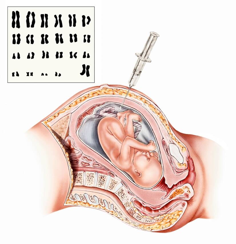 Amniocentesis , source: Getty Images