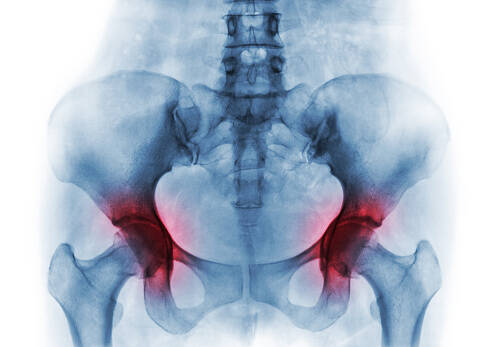 Does Grade 4 coxarthrosis end in hip replacement?