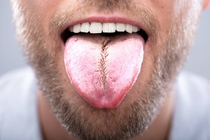 White Tongue: Causes and Treatment