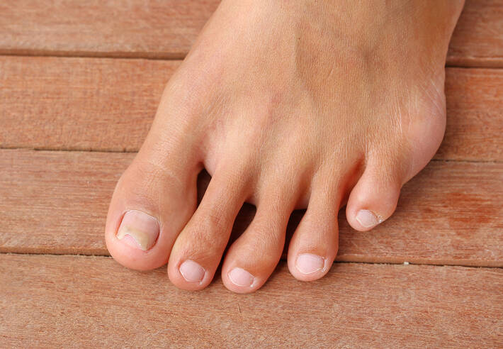 Deformed nails - what are their most common causes?