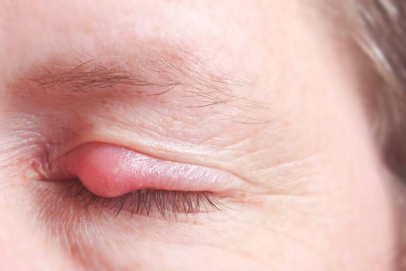 Eyelid lump: why does a fatty, white and other lump, eyelid cyst form?