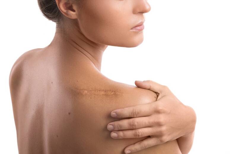 Scars on the skin: what do they arise from + what are the treatment options?